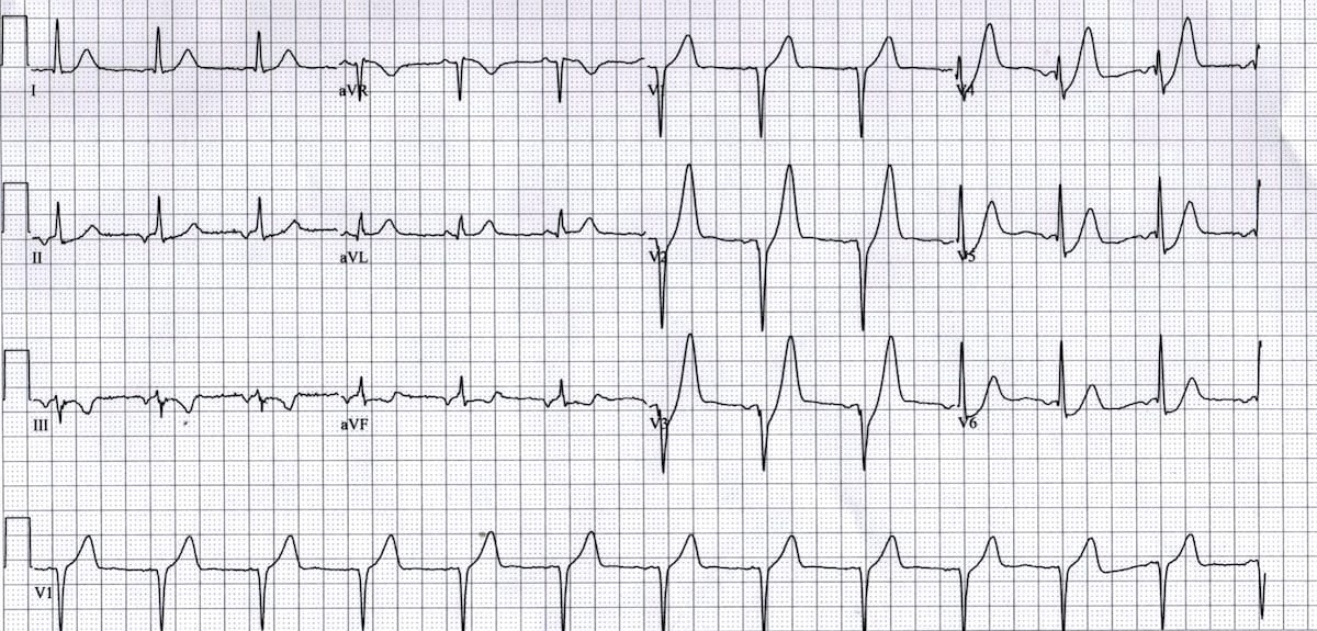 45-year-old male presents with sudden onset chest pain for the past 30 minutes. No ST elevation seen, but something isn’t right🤔
What’s your diagnosis?#ECG