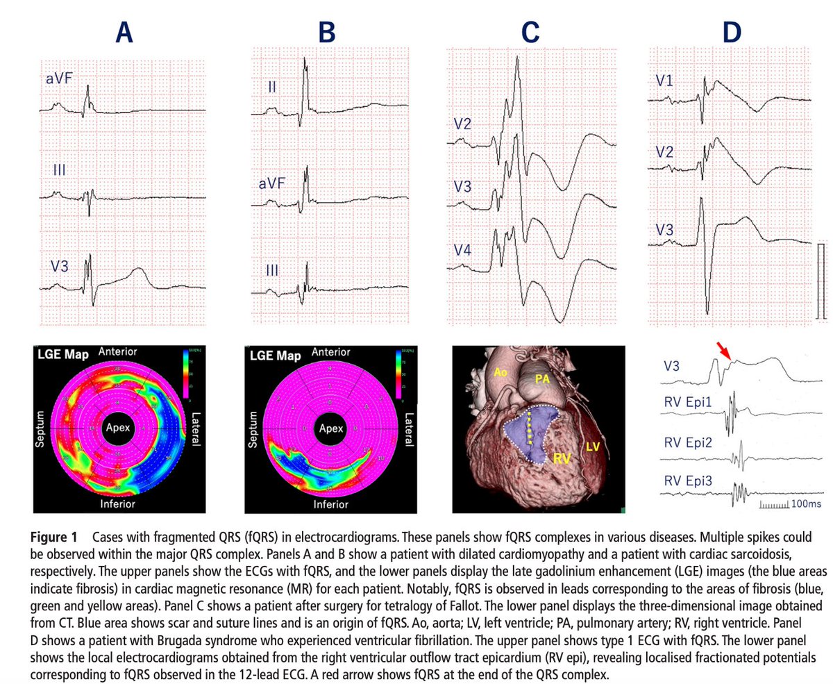 SeguraCardio's tweet photo. 📌#StateOTheArt analysis of #ECG findings in sudden cardiac death⚡️

#SCD #epeeps #LQTS #Brugada #ACS #MitralValveProlapse #ARVC https://t.co/wBRDH1fC87