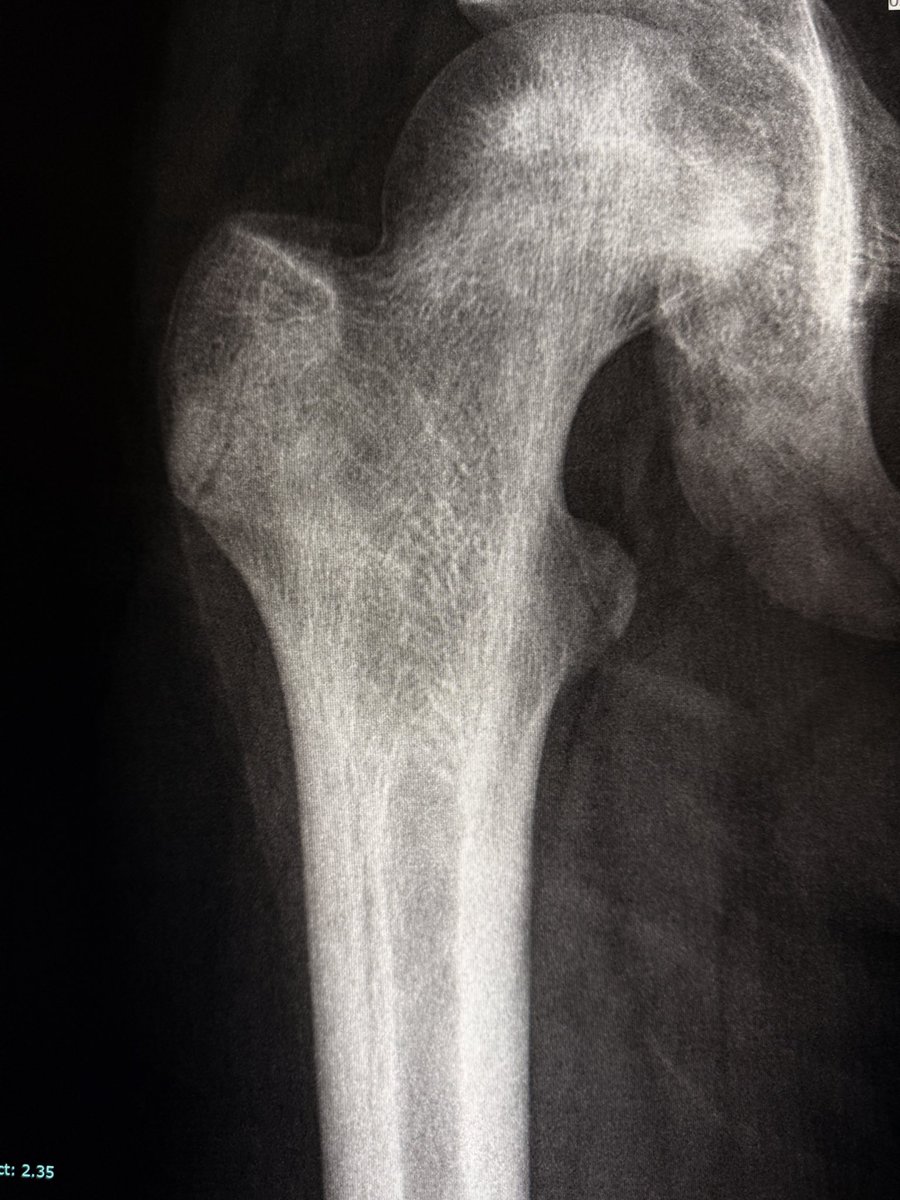 “Bone within bone” appearance of proximal femoral diaphysis in sickle cell disease. 

This appearance is due to chronic medullary bone infarction with a sclerotic rim (reflecting the new bone formed around old infarctions). 

The lucent rim between the cortex and the medullary