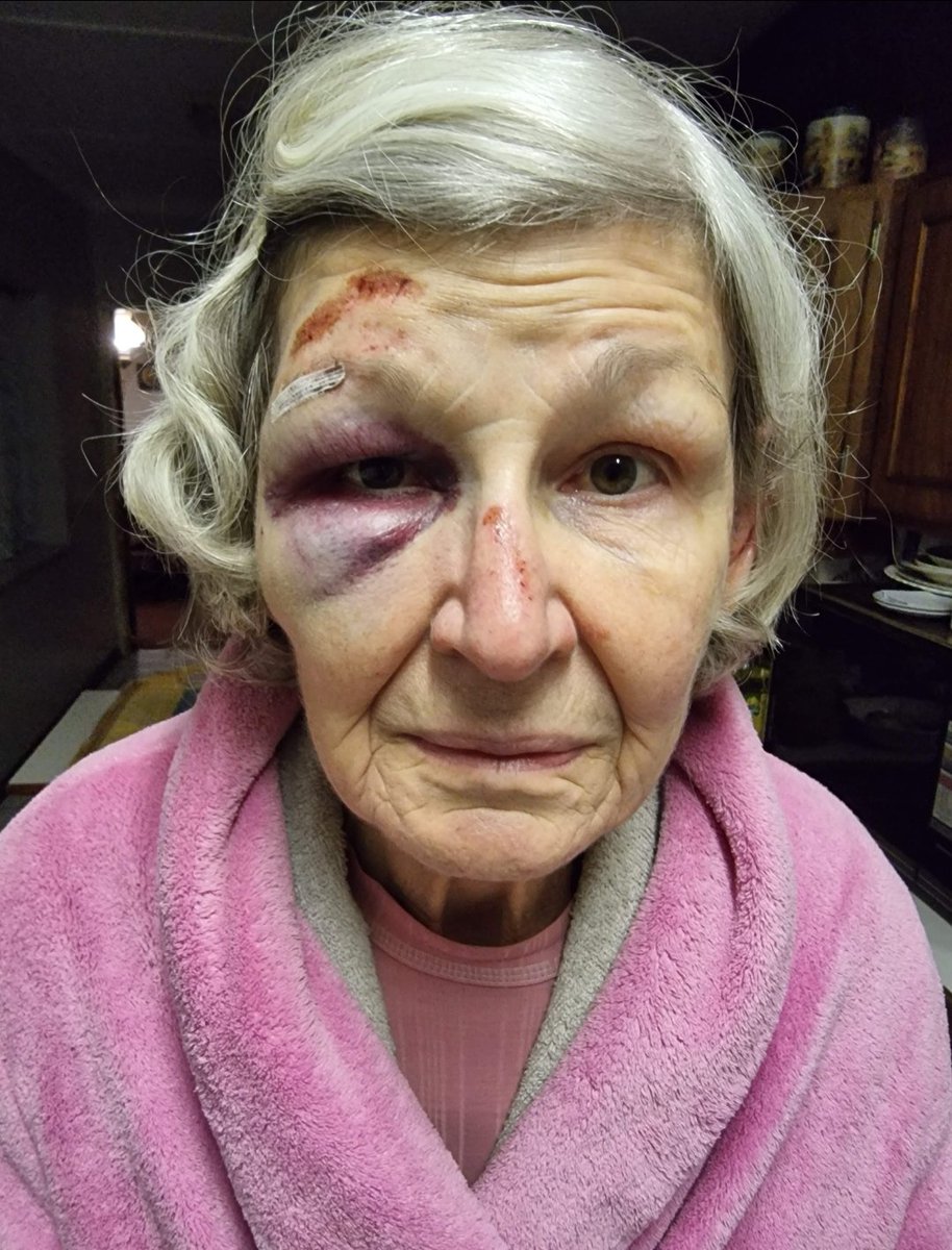 NicoleDPaterson's tweet photo. @elonmusk @DonaldTrump 
This was my 80 year old mother after a home invasion in Johannesburg, South Africa. The reason for this? Greed and arrogance! https://t.co/ycabrkXAjb
