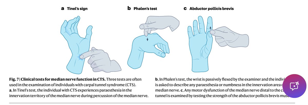 🧵 1/🔬¿Sabías que el síndrome del túnel carpiano (CTS) es la neuropatía por atrapamiento más común en el mundo?
Una revisión actualizada 
Carpal tunnel syndrome (2024) Nature Reviews, explica TODO lo que debes saber: epidemiología, fisiopatología, diagnóstico y manejo.
2/🧠 El