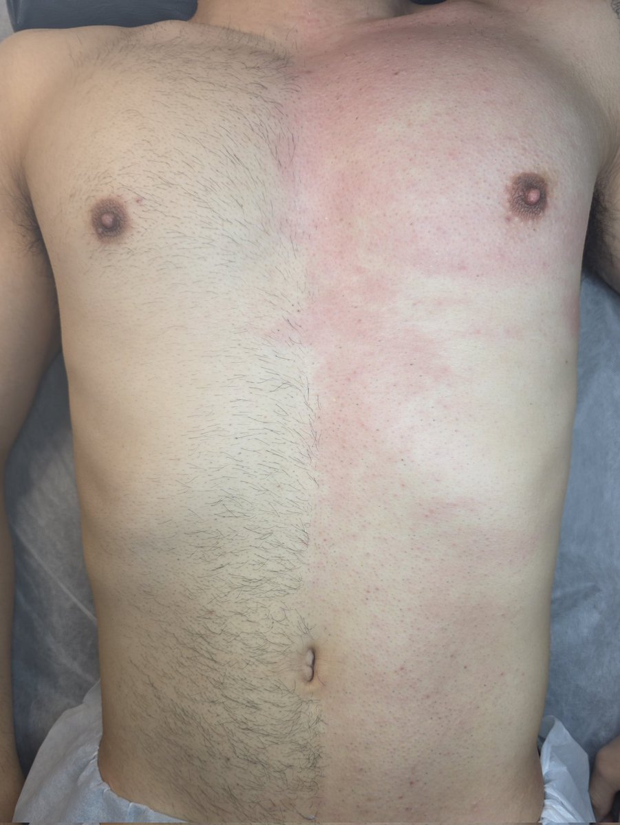 🏖여행을 위한 상반신 왁싱-!
탠다이브가 뽑아드립니다✨️

✓ 남자 원장님의 1:1 맞춤 예약 관리
✓ 시술 후 모든 기구, 용품 소독 및 1회 용품 사용
✓ 샤워실 완비

문의 : open.kakao.com/o/sXF03Mzf

#인천남자왁싱 #남자왁서 #인하대 #부평 #주안