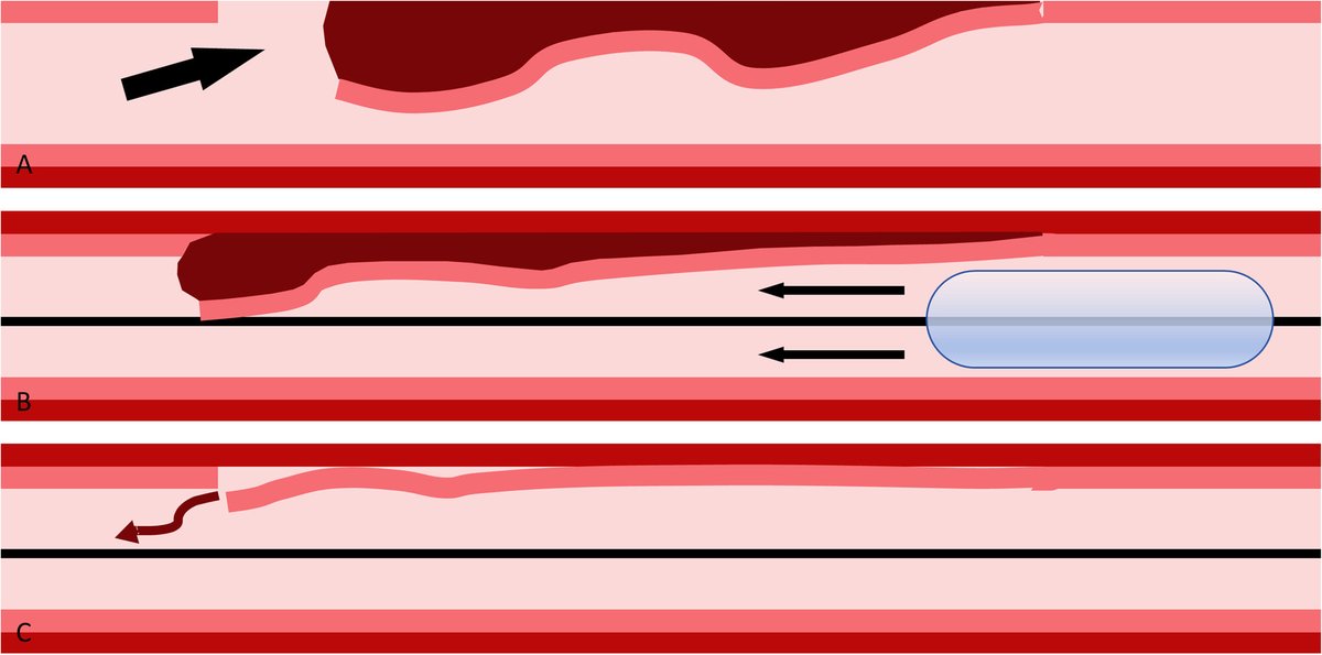 Giuseppe Biondi-Zoccai (@gbiondizoccai) on Twitter photo Definitely worth trying: the Small Balloon Low-Pressure Pullback Technique - a novel approach to tackle intramural hematoma onlinelibrary.wiley.com/doi/full/10.10… <a href="/ccijournal/">CCIjournal</a> Definitely worth trying: the Small Balloon Low-Pressure Pullback Technique - a novel approach to tackle intramural hematoma onlinelibrary.wiley.com/doi/full/10.10… <a href="/ccijournal/">CCIjournal</a>