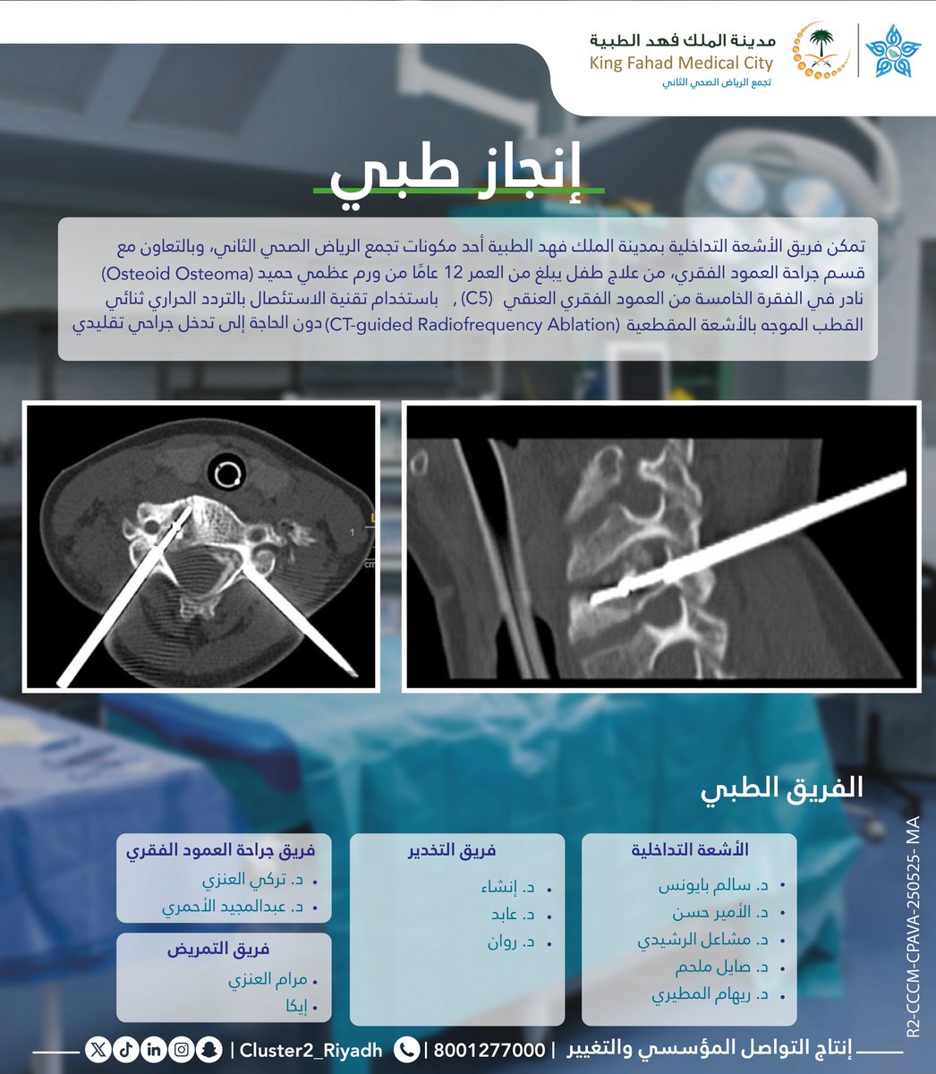 #إنجاز_طبي | استئصال ورم حميد نادر في الفقرة الخامسة بالتعاون بين فريقي الأشعة التداخلية وجراحة العمود الفقري بـ #مدينة_الملك_فهد_الطبية باستخدام تقنية التردد الحراري ثنائي القطب بدون جراحة تقليدية

#تجمع_الرياض_الصحي_الثاني