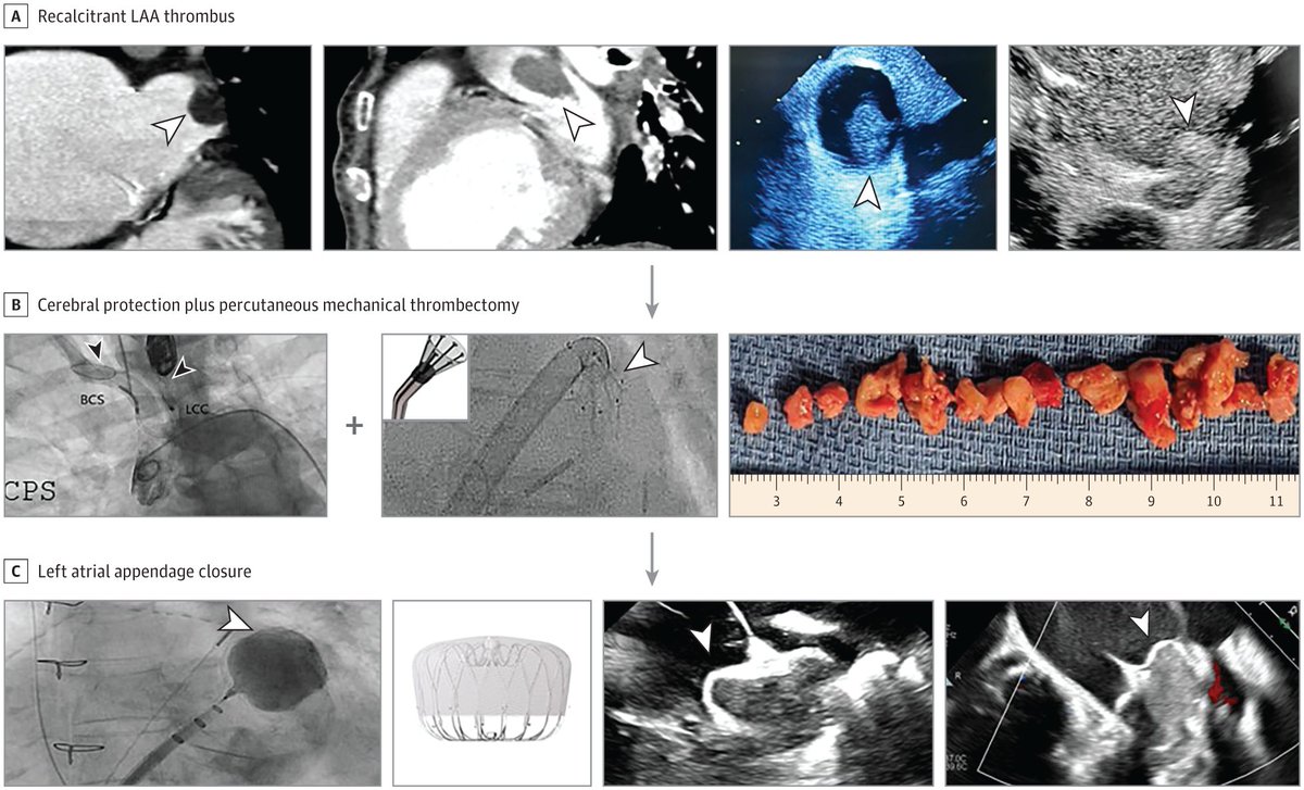 JAMA Cardiology (@jamacardio) on Twitter photo Temporary cerebral protection, percutaneous mechanical vacuum thrombectomy, and mechanical LAA closure is a promising Tx strategy for patients w persistent left atrial appendage thrombus despite optimal anticoagulation. ja.ma/4dwAgWt <a href="/VivekReddyMD/">Vivek Y. Reddy</a> <a href="/ParasuramMD/">Parasuram Krishnamoorthy MD</a> Temporary cerebral protection, percutaneous mechanical vacuum thrombectomy, and mechanical LAA closure is a promising Tx strategy for patients w persistent left atrial appendage thrombus despite optimal anticoagulation. ja.ma/4dwAgWt <a href="/VivekReddyMD/">Vivek Y. Reddy</a> <a href="/ParasuramMD/">Parasuram Krishnamoorthy MD</a>