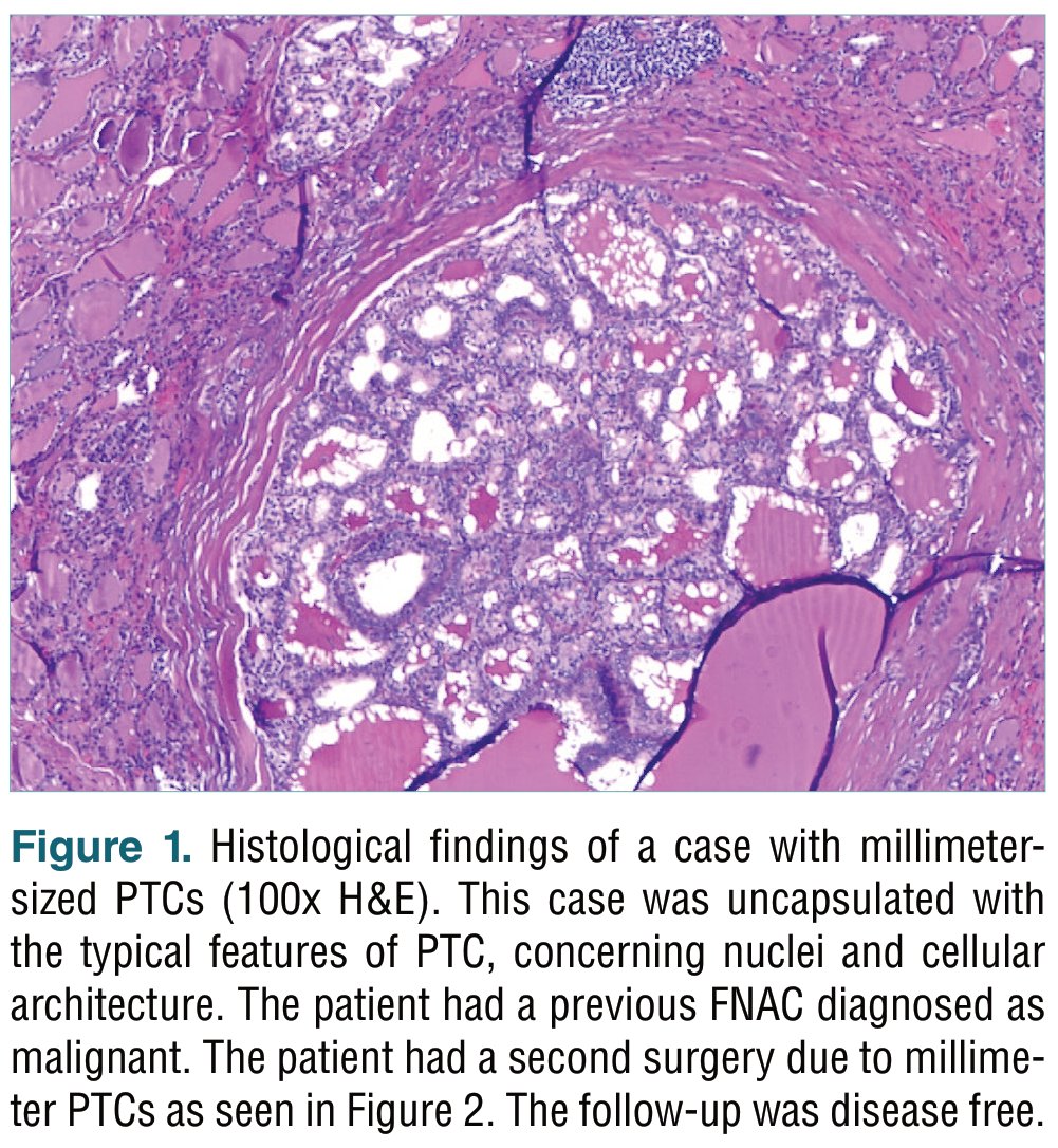 New article out!

Evaluation of papillary thryoid carcinoma and its variants: multifocality in thyroid lobectomy and completion thyroidectomy - a single tertiary center retrospective study

Read @ pathologica.it/article/view/1…

#Pathology #Pathologica