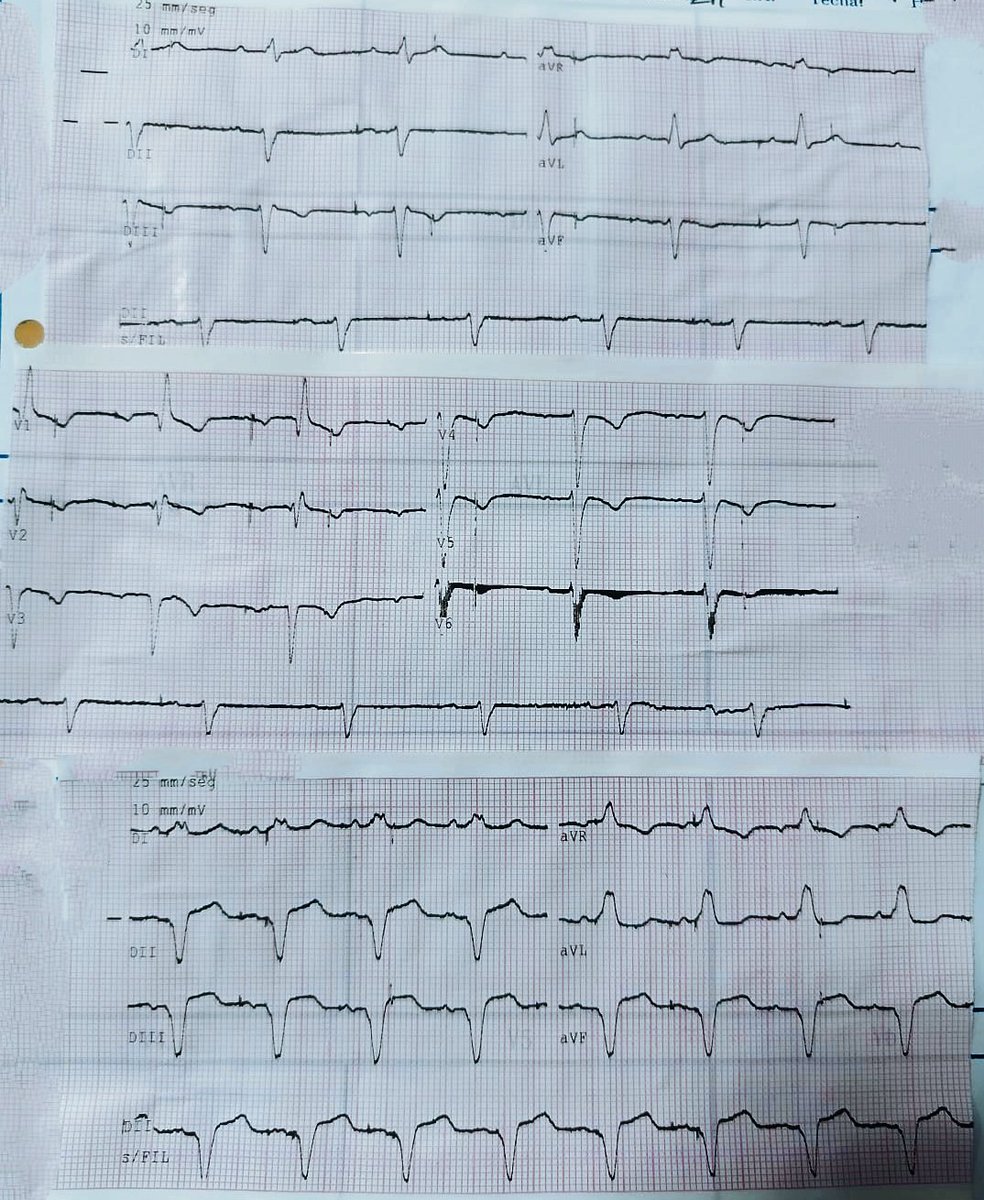 Nelson Polo Taborda (@nelsonpol) on Twitter photo 👴🏾74 y/o. History: Diabetes. 🏥 Syncope. Basal Ecg: AVB 1°, RBBB, LAHB ➡️ Pacemaker.
What's the matter in T wave? Programation trouble? 🤔 <a href="/AThomazAndrade/">Antonio Thomaz de Andrade, MD 🇧🇷</a> <a href="/Teebi_MD/">Ahmed Teebi, MD MPH🗝️</a> <a href="/juanquidh/">Juan Diaz Heredia</a> <a href="/SparkyDeviceRN/">Sparky, Device RN</a> <a href="/taquicarlos/">Carlos Lopez</a> <a href="/MosqueaRubelin/">Dr. Rubelin mosquea</a> <a href="/ramonis_jesmar/">Jesmar Ramonis</a> <a href="/narrowQRS/">JMC</a> 👴🏾74 y/o. History: Diabetes. 🏥 Syncope. Basal Ecg: AVB 1°, RBBB, LAHB ➡️ Pacemaker.
What's the matter in T wave? Programation trouble? 🤔 <a href="/AThomazAndrade/">Antonio Thomaz de Andrade, MD 🇧🇷</a> <a href="/Teebi_MD/">Ahmed Teebi, MD MPH🗝️</a> <a href="/juanquidh/">Juan Diaz Heredia</a> <a href="/SparkyDeviceRN/">Sparky, Device RN</a> <a href="/taquicarlos/">Carlos Lopez</a> <a href="/MosqueaRubelin/">Dr. Rubelin mosquea</a> <a href="/ramonis_jesmar/">Jesmar Ramonis</a> <a href="/narrowQRS/">JMC</a>
