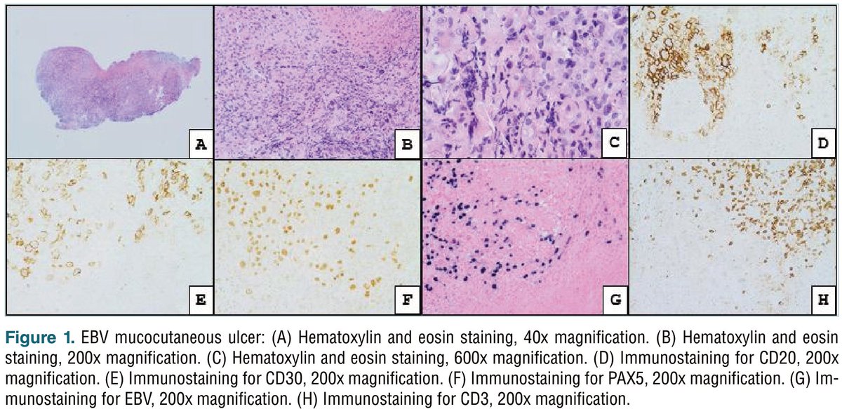 New #OpenAccess article published in #Pathologica

Head and neck hematolymphoid proliferations: what is new?

Read @ pathologica.it/article/view/1…

#Pathology