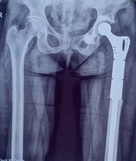 These " metals" called implants that Surgeons put in the human bodies do not cause cancer. They are safe and can be kept in the body for life.