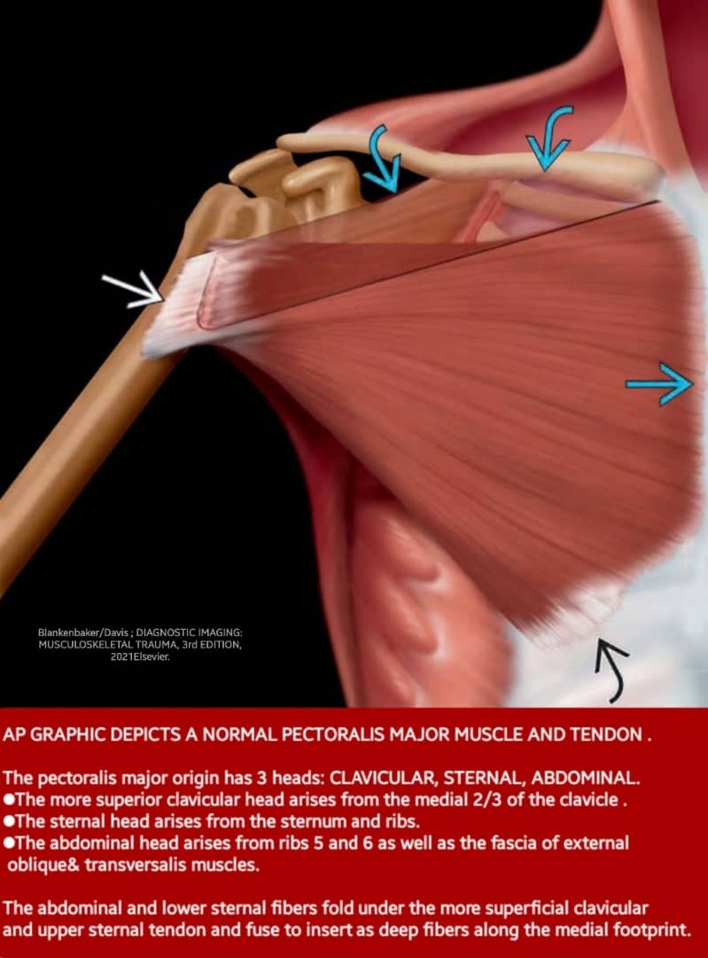 🛑Some facts about PECTORALIS MAJOR:
✓ 3 muscle heads
Clavicular; Sternal: often divided into upper &amp; lower;
Abdominal

✓Normal tendon
- Thin (3-5mm) AP
- 4-6 cm craniocaudal
- Inserts onto lateral lip of inferior bicipital groove
-Lies anterior to biceps&amp; coracobrachialis
