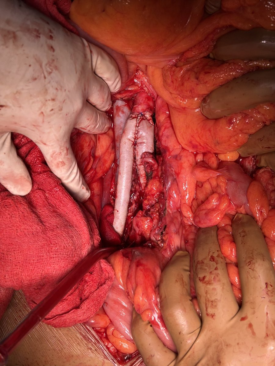 DrPShivanesan (@pshivanesandr) on Twitter photo Mycotic IRAAA open repair with Bovine pericardial graft. Complete video in this link
youtu.be/juB4ng9PT00?si…
<a href="/PrajnaKota/">Prajna Kota MS, MCh</a> #aortaed Mycotic IRAAA open repair with Bovine pericardial graft. Complete video in this link
youtu.be/juB4ng9PT00?si…
<a href="/PrajnaKota/">Prajna Kota MS, MCh</a> #aortaed