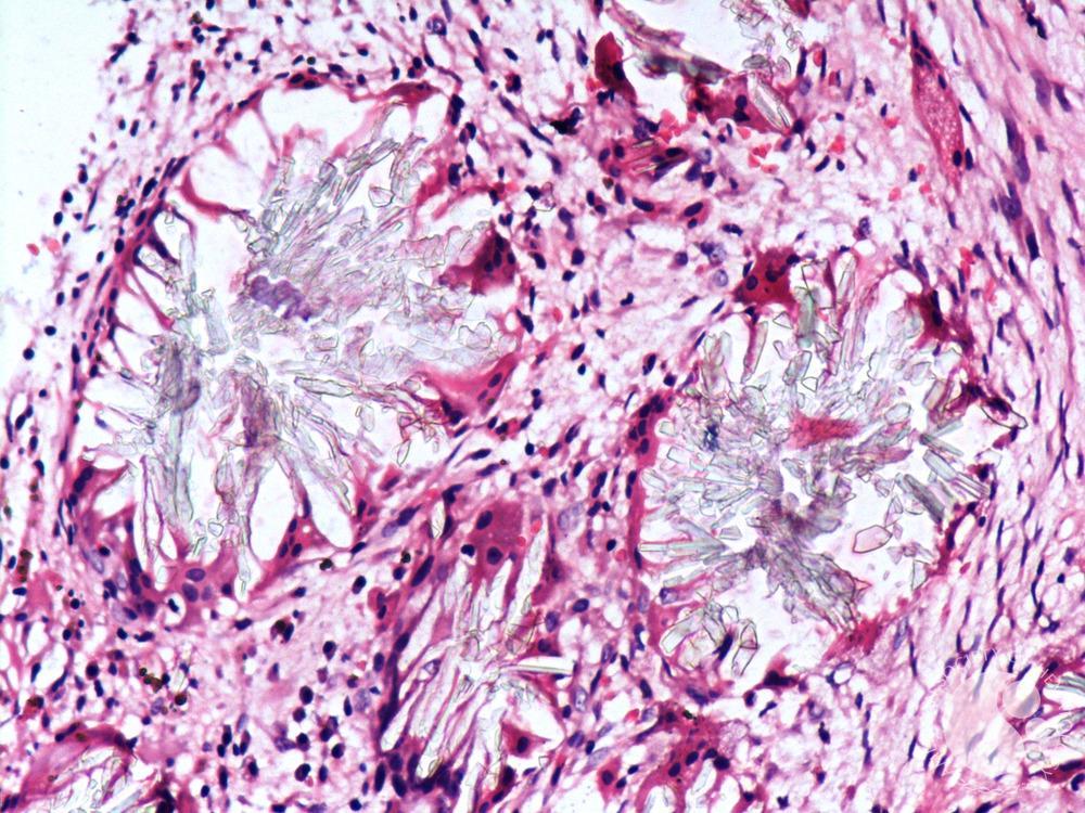 7-year-old boy

Presents with: Fatigue, pallor, and easy bruising
Hepatosplenomegaly, no lymphadenopathy

Pancytopenia, ESR ↑, Cr 5.8 mg/dL

Bone Marrow Biopsy
Showing 

What is the diagnosis 
And treatment of choice?
#ashimagebank
<a href="/nihardesai7/">𝗡𝗶𝗵𝗮𝗿 𝗗𝗲𝘀𝗮𝗶 MD, DM</a>