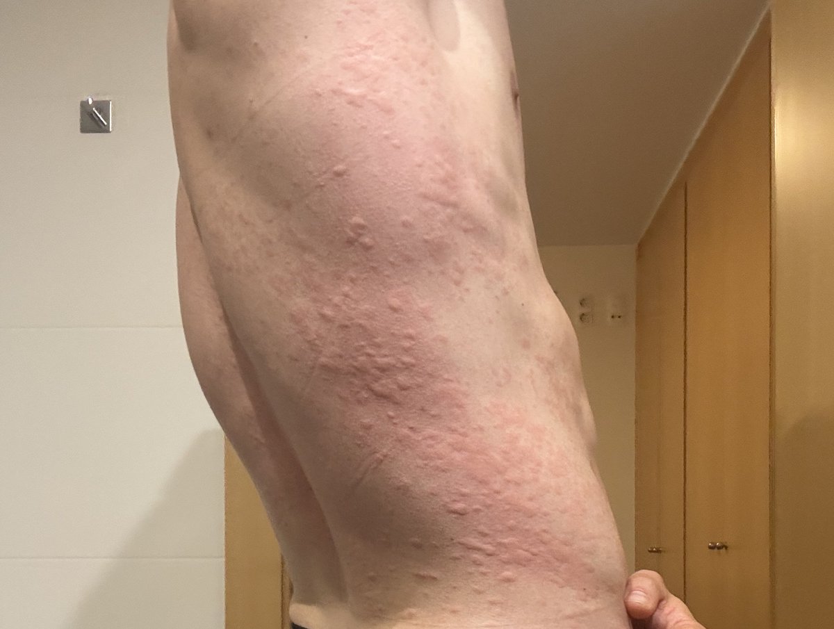 Me he levantado hoy con una reacción alérgica, lleno de manchas por todo el cuerpo justo hoy el dia del Evento 😵‍💫

Ya fui al hospital y me pincharon para bajar la reacción, así que si todo sigue bien nos vemos esta tarde :)