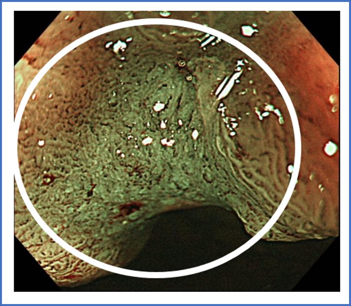 Lumír Kunovský (@lumirkunovsky) on Twitter photo 🔍 🔥 Optical assessment of advanced #colorectal #polyps survey and quiz🔥
👉 lnkd.in/dqGDfPJM 👈
💥 How did you score❓️
🔴 Are you confident in assessing advanced polyps❓️
🔵 <a href="/ESGE_news/">ESGE</a> 🔵
🟣 <a href="/Y_ECCO_IBD/">Y-ECCO</a> 🟣
🔴 <a href="/drmanmeetm/">Dr Manmeet Matharoo</a> 🔴
⚪️ <a href="/KralJan/">Jan Král</a>
<a href="/EndoscopyNow/">EndoscopyNow</a>
#GITwitter 🔍 🔥 Optical assessment of advanced #colorectal #polyps survey and quiz🔥
👉 lnkd.in/dqGDfPJM 👈
💥 How did you score❓️
🔴 Are you confident in assessing advanced polyps❓️
🔵 <a href="/ESGE_news/">ESGE</a> 🔵
🟣 <a href="/Y_ECCO_IBD/">Y-ECCO</a> 🟣
🔴 <a href="/drmanmeetm/">Dr Manmeet Matharoo</a> 🔴
⚪️ <a href="/KralJan/">Jan Král</a>
<a href="/EndoscopyNow/">EndoscopyNow</a>
#GITwitter