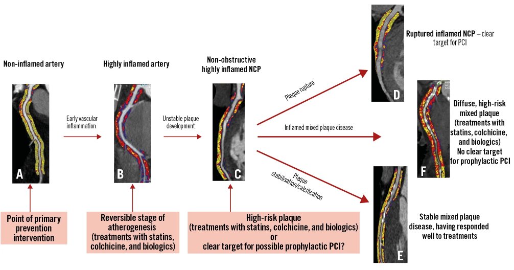 Coronary inflammation on #CCTA offers prognostic value beyond plaque burden in #PCI patients. Residual inflammatory risk may guide long-term therapy decisions, including statin use and anti-inflammatory strategies.  #InterventionalCardiology  #EAPCI
ow.ly/kTAj50W5op5