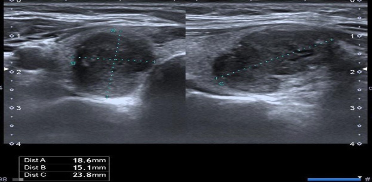 Enhancing the Detection of Malignancy in Thyroid Nodules by Assessing Longitudinal Diameter-to-Anteroposterior Diameter Ratio dlvr.it/TLD9Hb