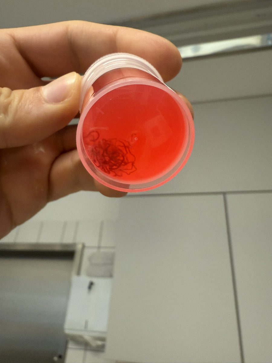 🔬 Yesterday’s EUS-FNB of a large pancreatic mass 🧠
Always fascinating to see how others approach this!
💉 Which technique do you prefer for sampling?
•🌀 Slow-pull technique
•🧲 Dry suction
•💧 Wet suction technique
•🔬 Macroscopic on-site evaluation (MOSE) or ROSE?