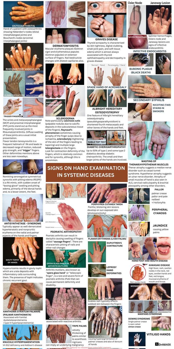 drsthanus's tweet image. The image depicts various hand conditions associated with systemic diseases.

 pin.it/5VvEcDVnF