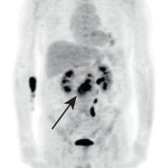 vascularis's tweet image. Another interesting #EJVESforum Vol. 63, 2025 report on #endograft explantation and salvage repair after #FEVAR from Torre et al 🇨🇭 "A Case of Successful Explantation of an Infected #Fenestrated #Aortic Endograft Using a Composite Xeno/Biosynthetic In Situ Reconstruction"…