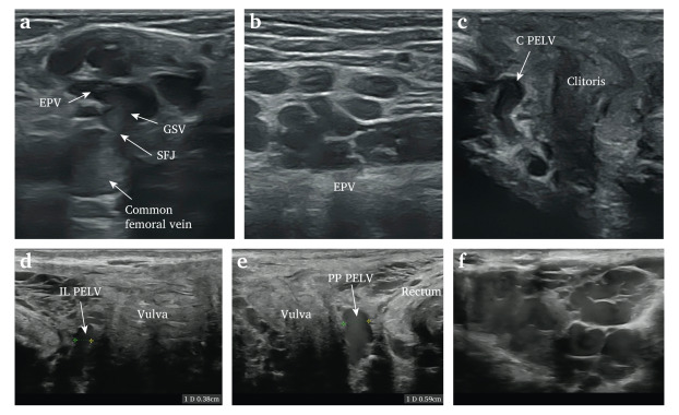 vascularis's tweet image. Another interesting #EJVESforum Vol. 63, 2025 report on simple and effective usage of #sclerotherapy for lower limb and pelvic source #varicose #veins from Jaworucka-Kaczorowska et al 🇵🇱🇧🇪"Bottom up Treatment for Vulvar and Lower Extremity Varicose Veins of Pelvic Origin: A Case…