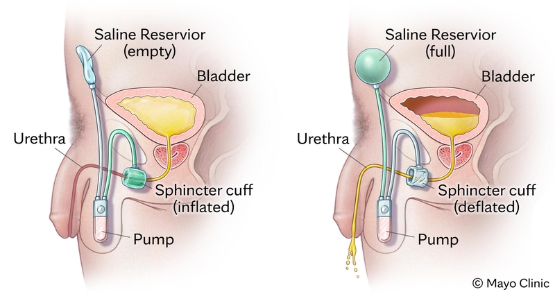 Mayo Clinic Urology (@mayourology) on Twitter photo 👏Exceptional work on the incredible first long-term study on Artificial Urinary Sphincter Placement and validated long-term quality of life improvement for men following prostatectomy for prostate cancer treatment. <a href="/DanielElliottMD/">DanielElliottMD</a> Austin Martin MD
vist.ly/3n6ahgv #AUS 👏Exceptional work on the incredible first long-term study on Artificial Urinary Sphincter Placement and validated long-term quality of life improvement for men following prostatectomy for prostate cancer treatment. <a href="/DanielElliottMD/">DanielElliottMD</a> Austin Martin MD
vist.ly/3n6ahgv #AUS