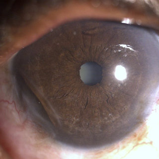 Differential diagnoses:

1. Pellucid Marginal Degeneration
2. Inferior Keratoconus
3. PUK
4. Post-refractive surgery ectasia

#MedTwitter #ophthalmology #neetpg 
Image from google