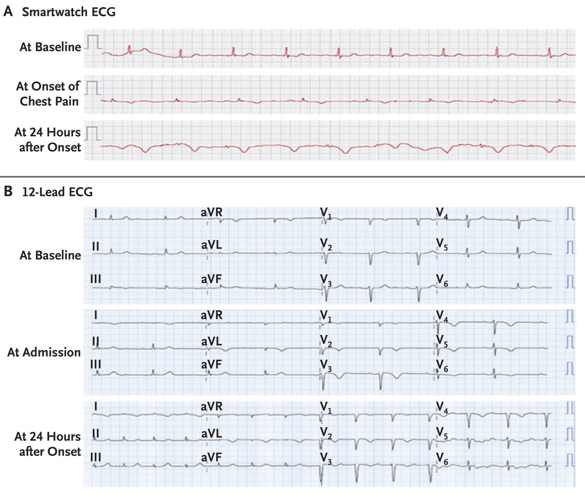 Diagnosing heart damage by a smartwatch.
Turned out to be Takotsubo cardiomyopathy ("broken-heart" syndrome) <a href="/NEJM/">NEJM</a>
nejm.org/doi/full/10.10…