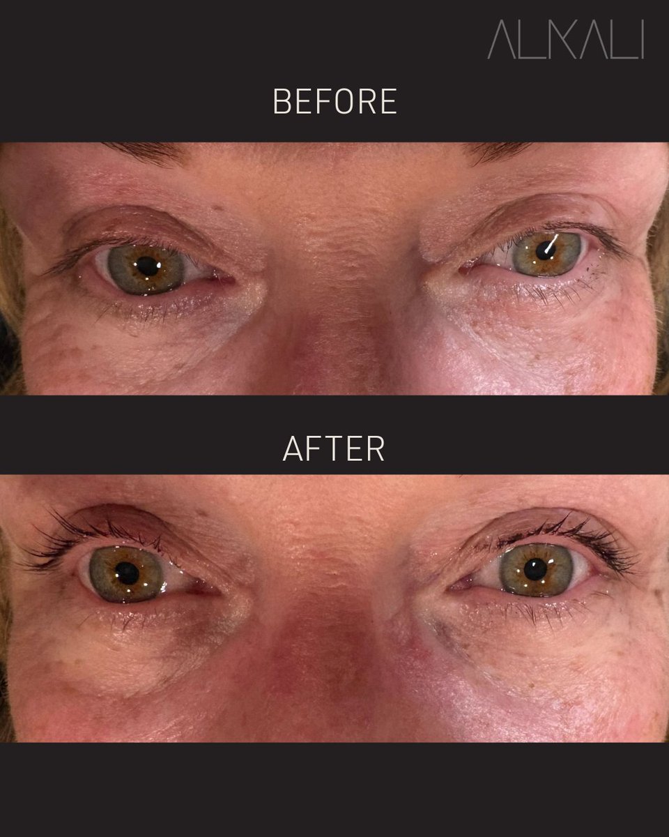 AlkaliHair's tweet image. Want to wake up with flawless lashes? A #lashlift and tint is a low maintenance, high-impact way to enhance your natural beauty! Check out this lash lift and tint by Jes Harding!

Ready for beautiful lashes? Book with Jes online or call 336-724-1453.
bit.ly/4mVBPlc