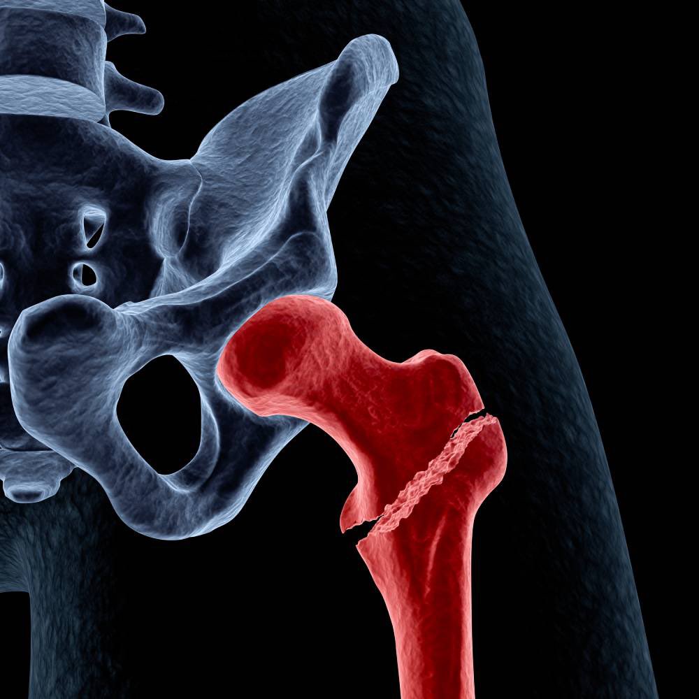 BullockGeo12085's tweet photo. Direct Anterior approach to hip replacement https://t.co/PvzAi4u4fR