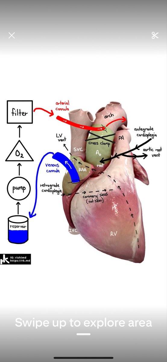 What is cardio pulmonary bypass?