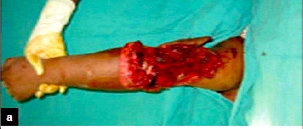 If you are wondering what an injury to Officer John O'Keefe's arm may look like, here is a clinical photograph of a typical motor vehicle sideswipe injury to the elbow  Justice for Officer O’Keefe &amp; Karen Read #KarenReadTrial #KarenReadTrial2 #KarenRead 
#FKR