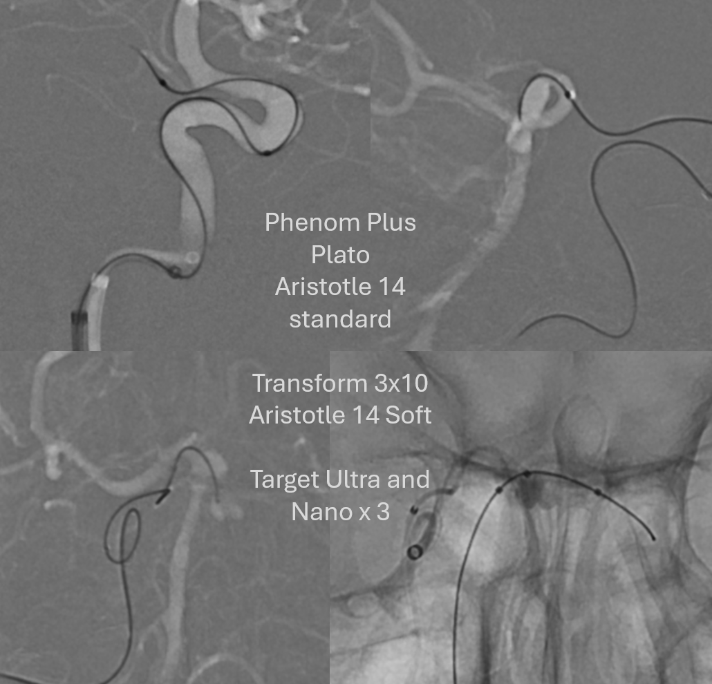 neuroangio1's tweet photo. 🧠 New Case Alert! Challenging wide-neck SCA aneurysm tackled with coiling via the PCOM — an elegant solution for complex vascular anatomy.📚 Dive into the case: https://t.co/SOLnxJY7LB #NeuroIR #BANANA #Endovascular https://t.co/EmeCNbv4UW