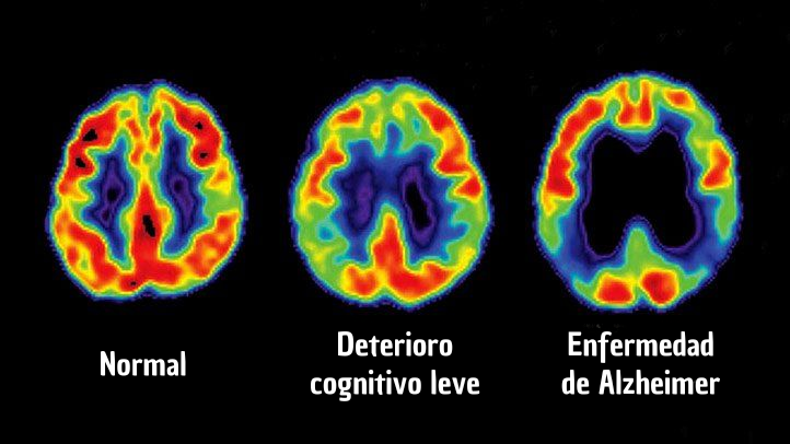 despertarsalud_'s tweet photo. Olvida todo lo que sabes sobre el Alzheimer: 

Solo el 5% de los casos son genéticos. 

El 95% restante tiene una causa que te impactará. 

La realidad sobre el Alzheimer está aquí, y no puedes ignorarla: 🧵 https://t.co/1pAQbMqH8V