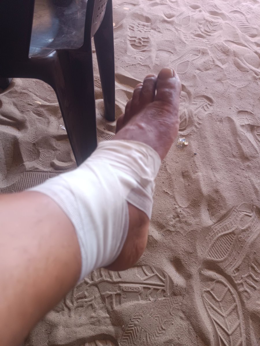 I injured my leg and it has severe inflammation from the effects of displacement. 
Please donate for treatment and to buy flour for my children. 
#EidAlAdha #fypシ #fypシ゚viral