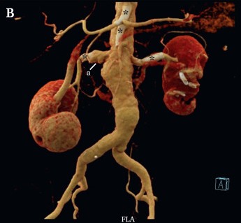 vascularis's tweet image. Another interesting #EJVESforum Vol. 63, 2025 paper from Wenkel et al 🇩🇪 on #aortaed #sarcoma "Undifferentiated Intimal Sarcoma of the Visceral Aorta With Recurrent Renovisceral Ischaemia Misdiagnosed as Takayasu's Arteritis" #OpenAccess doi.org/10.1016/j.ejvs… @EJVES_ESVS
