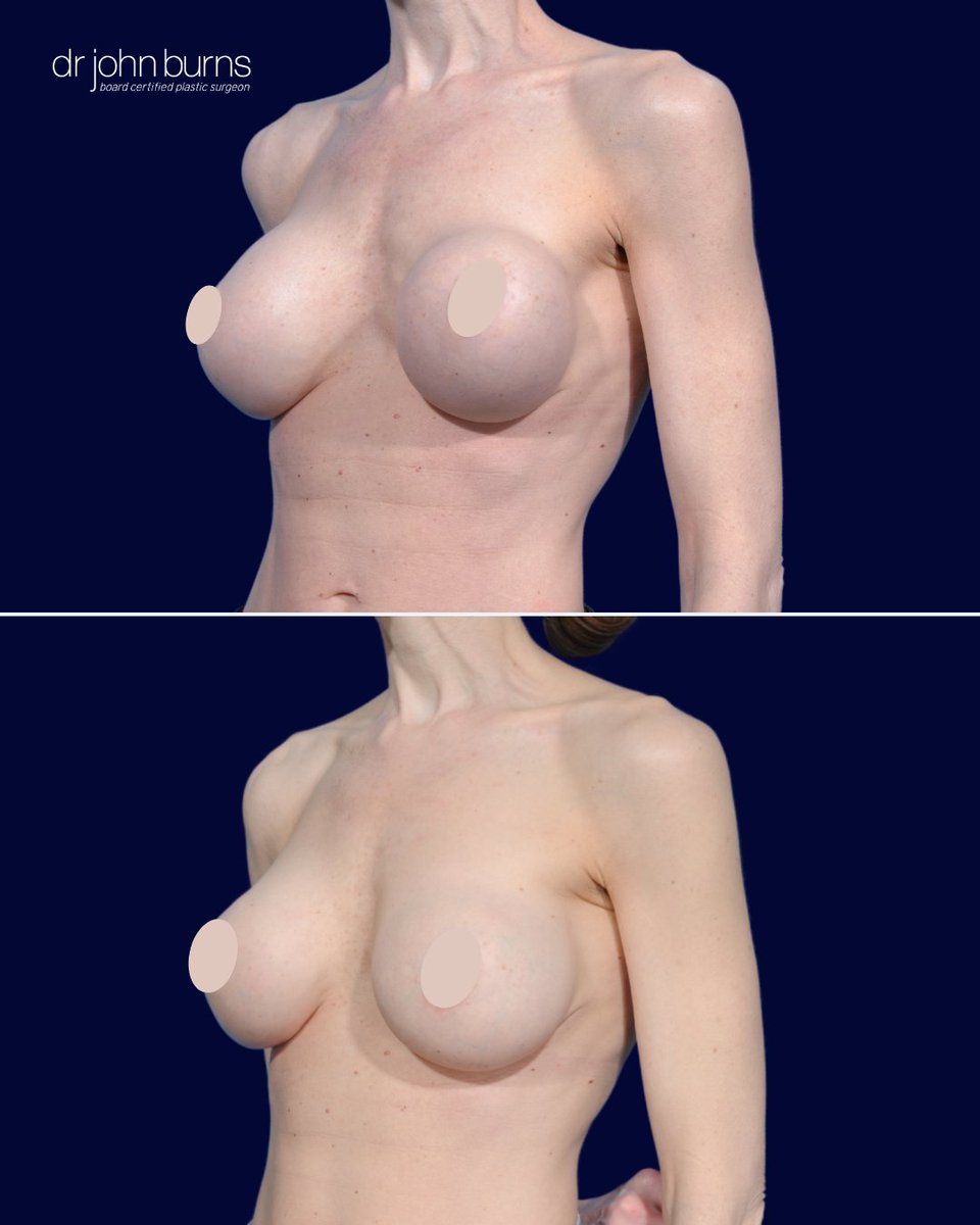 drjohnburns's tweet photo. ,
She lived with painful, disfigured implants from another surgeon. Dr. Burns removed the hardened capsules, placed new implants under the muscle, and reinforced with Durasorb mesh. Now, her breasts are soft, symmetric, and pain-free. #BreastRevision #DrBurns #CapsularContracture https://t.co/eBK2RlaujX