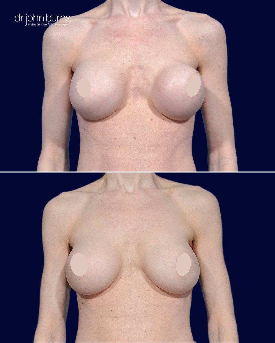 drjohnburns's tweet photo. ,
She lived with painful, disfigured implants from another surgeon. Dr. Burns removed the hardened capsules, placed new implants under the muscle, and reinforced with Durasorb mesh. Now, her breasts are soft, symmetric, and pain-free. #BreastRevision #DrBurns #CapsularContracture https://t.co/eBK2RlaujX