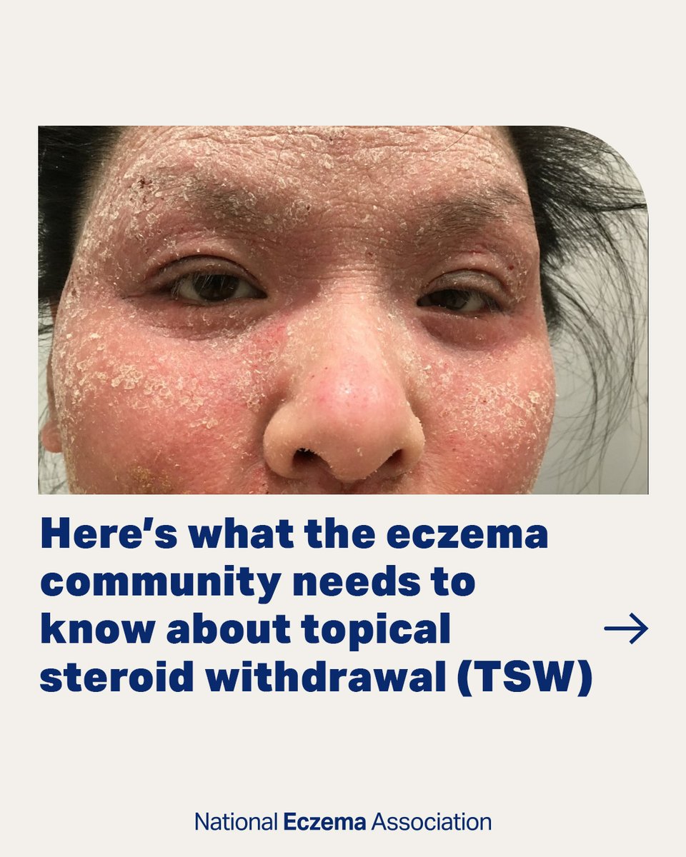 nationaleczema's tweet photo. We collaborated with top doctors, @ITSANnonprofit
and the #TSW community to learn what people with #eczema and their caregivers need to know about #TopicalSteroidWithdrawal.

Read the article: https://t.co/dFt9jmXMtx

#GetEczemaWise #ThisIsNotEczema #TSW #TSWAwareness https://t.co/8klHIT73B5