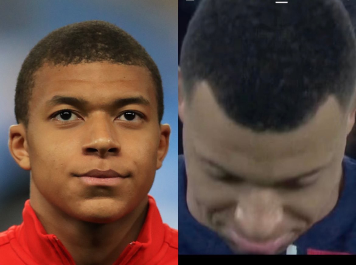 🇫🇷❌🧑‍🦲 INSOLITE – Kylian Mbappé présente des signes de début de CALVITIE.

Selon un spécialiste, des éléments permettent d’affirmer avec certitude que Kylian Mbappé développera une calvitie.