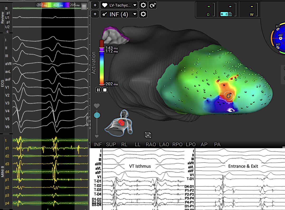“A second VT ablation was performed in a patient with ischemic cardiomyopathy using the AFFERA system, with a clear depiction of the diastolic isthmus ⁦<a href="/SteliosDragasis/">Stelios</a>⁩ ⁦<a href="/Kariki_O/">Ourania Kariki</a>⁩ ⁦<a href="/ipetemil/">Panagiotis Mililis</a>⁩ ⁦<a href="/athsaplaouras/">Athanasios Saplaouras</a>⁩ ⁦<a href="/K_Letsas/">Konstantinos Letsas</a>⁩ ⁦<a href="/PetrosSkalidis/">Petros Skalidis</a>⁩