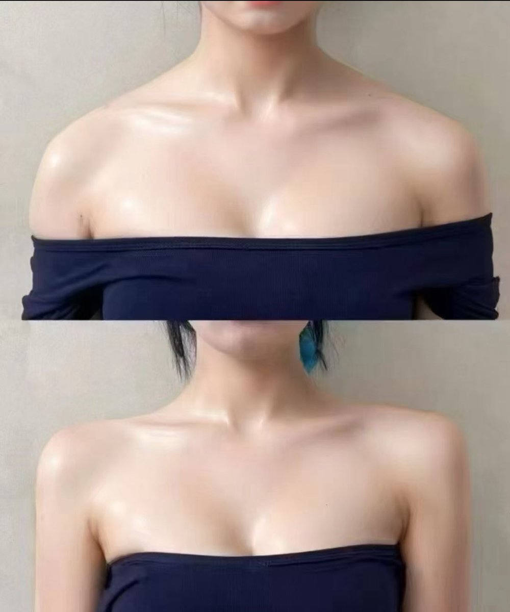 diet_nagomin's tweet image. 不細工な肩周りこれで全て解決する。
【　撫で肩、猫背、盛り肩、ハミ肉　】