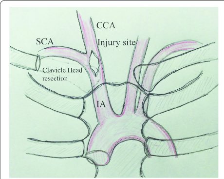 شاركت هذا الفيديو قبل ٤ سنوات لتعليم الزملاء وفي فجر ثاني يوم العيد اجبرت على عمل sternotomy بنفس الطريقة للسيطرة على نزيف من brachiocephalic artery لمريض لديه zone 1 expanding haematoma 
و اكثر من لتر  haemothorax. 

استطيع التحدث لساعات عن الدروس التي يمكن استفادتها وسألخص ذلك