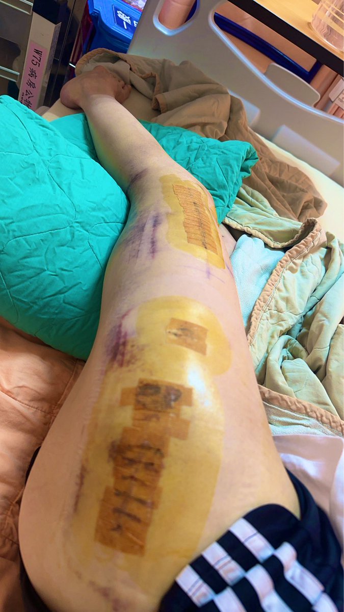 Juwern96's tweet image. Day 5 after my intramedullary nail repalce surgery… heyyy bones~ can you please be extra good and heal up super fast? I’ve got a super important date with the Pro Tour Cosplay in Singapore! Don’t let me down~ onegai~ 🥺🦴 🦵🏻