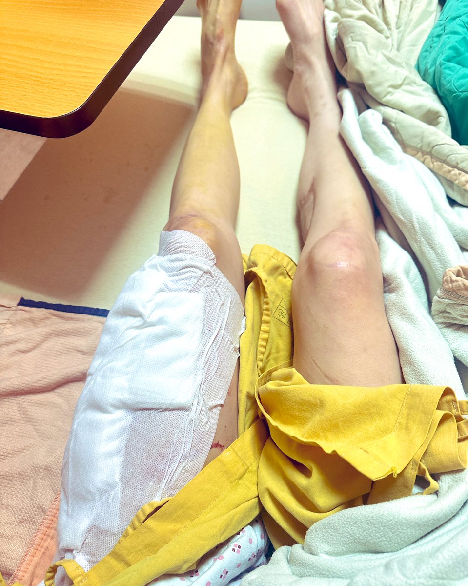 Juwern96's tweet image. Day 5 after my intramedullary nail repalce surgery… heyyy bones~ can you please be extra good and heal up super fast? I’ve got a super important date with the Pro Tour Cosplay in Singapore! Don’t let me down~ onegai~ 🥺🦴 🦵🏻