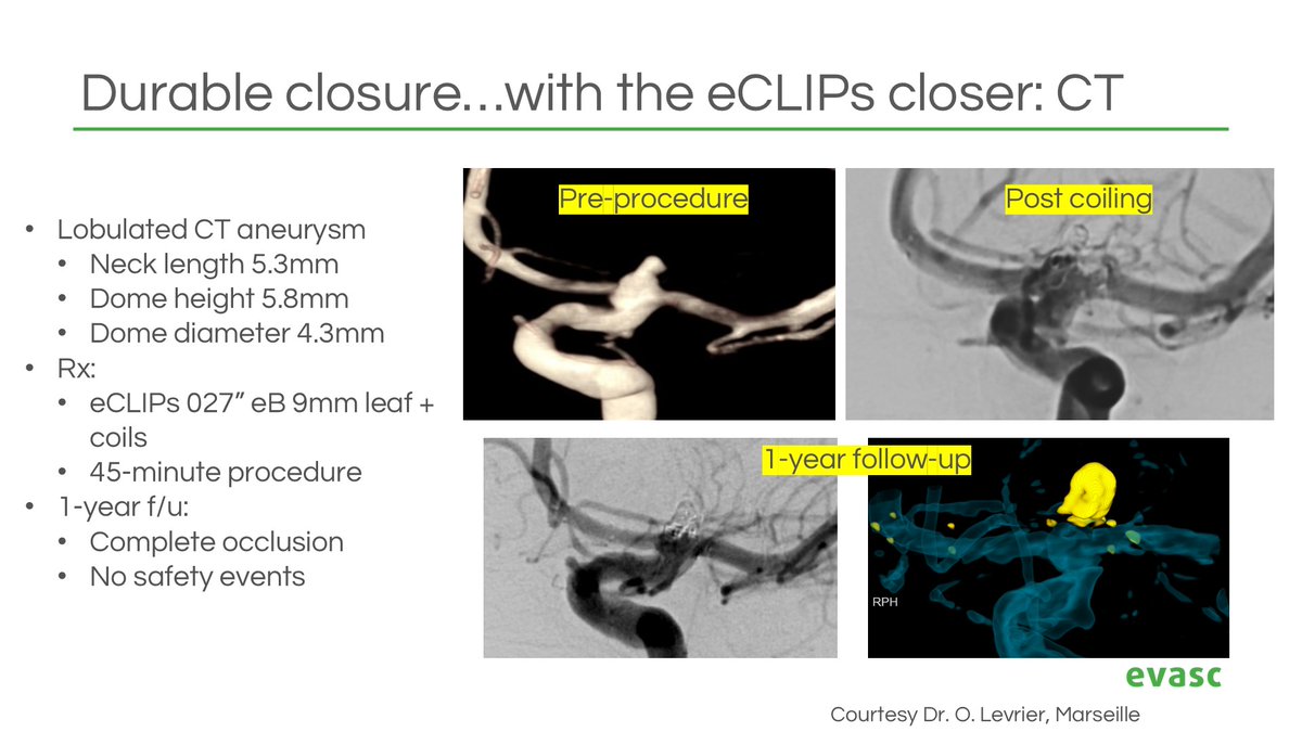 Evasc congratulates Pr/Dr Olivier Levrier, Marseille, for illustrating the durable occlusion characteristics of eCLIPs for intracranial bifurcation aneurysms.