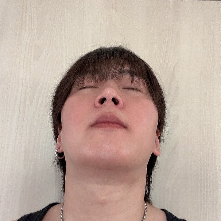 jin_623_'s tweet photo. 〜ダウンタイム10ヶ月目〜

最近は「変わる」よりも「馴染む」感覚が強くなってきた

だれかに何か言われることも減って
自分自身も過剰に意識しなくなったし
自分の顔としてちゃんと受け入れられるようになってきたってことなんかな✌️

#id美容外科 #韓国整形 #骨切り
#両顎手術 #Vライン形成 https://t.co/RMq6FIeyiw