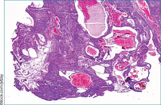 Oncology Times (@oncologytimes) on Twitter photo A team from The Jackson Laboratory in Maine and <a href="/uconnhealth/">UConn Health</a> has developed an automated deep learning #AI model capable of classifying pediatric soft tissue #sarcomas with accuracy comparable to that of experienced pathologists. ow.ly/Kke150W5BRa A team from The Jackson Laboratory in Maine and <a href="/uconnhealth/">UConn Health</a> has developed an automated deep learning #AI model capable of classifying pediatric soft tissue #sarcomas with accuracy comparable to that of experienced pathologists. ow.ly/Kke150W5BRa