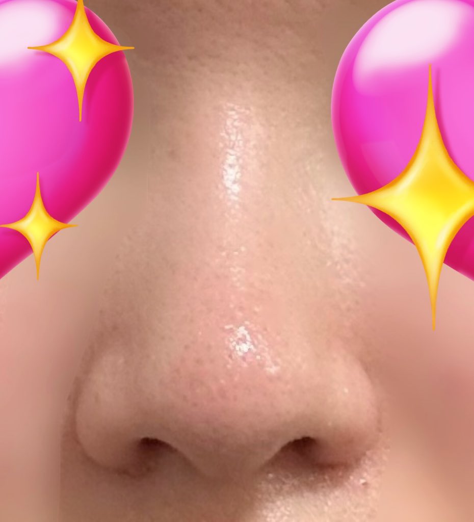 ShiroButaUsagi's tweet photo. 鼻フル整形DT2ヶ月
DT1ヶ月の頃とあまり変わってない気がするけど、相変わらずナチュラルで満足！！
あとは小鼻の傷が綺麗になってくれたら嬉しい🥲だんだん自然に笑えるようになってきたからあと数ヶ月の辛抱🥹
#ビギン美容外科 #イジュチョル院長 #渡韓 https://t.co/hPySEnGOir