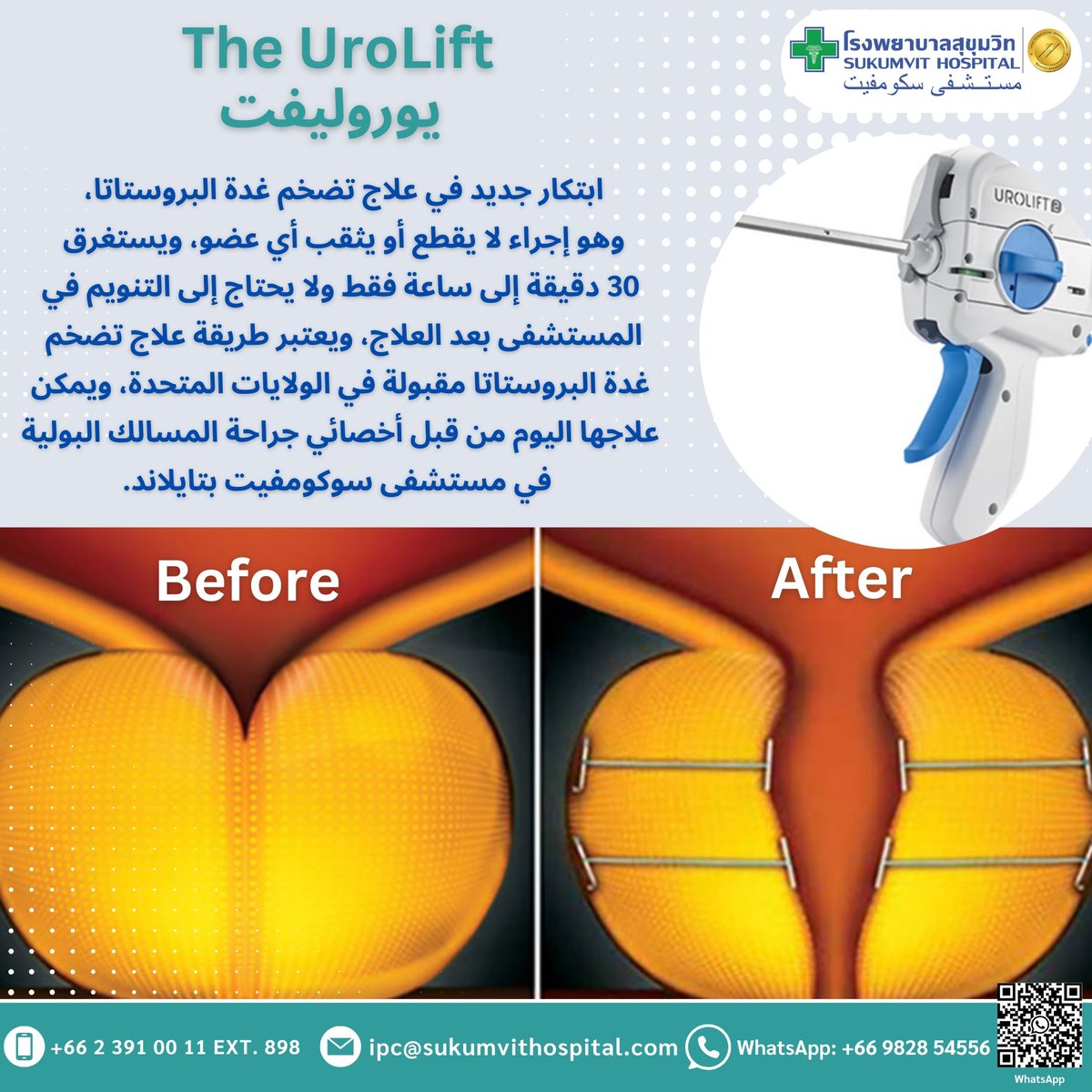 📍ابتكار جديد في علاج تضخم غدة البروستاتا، وهو إجراء لا يقطع أو يثقب أي عضو، ويستغرق 30 دقيقة إلى ساعة فقط ولا يحتاج إلى التنويم في المستشفى ، ويعتبر طريقة علاج تضخم
📍غدة البروستاتا مقبولة في الولايات المتحدة، ويمكن علاجها اليوم من قبل أخصائي جراحة المسالك البولية