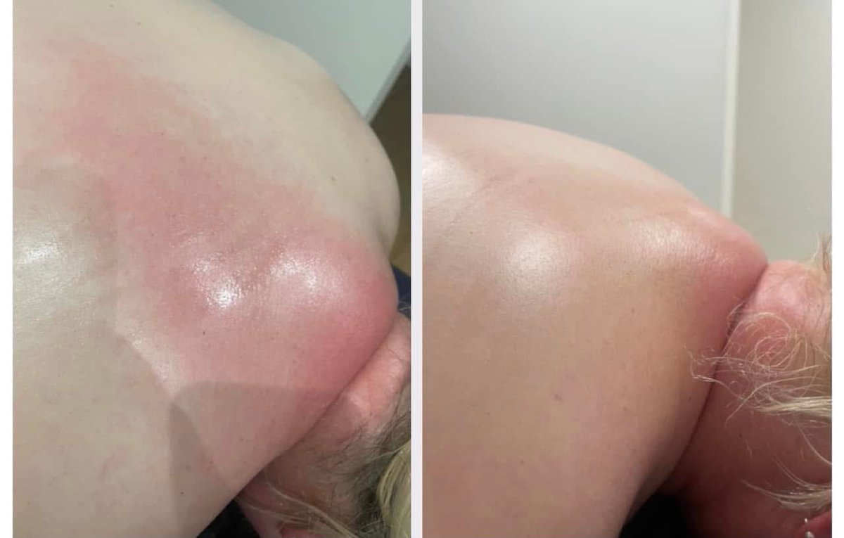RebeccaTalbot02's tweet photo. 5 months of deep tissue on this hump and finally seeing big progress!
Deep tissue provides stimulation to the muscles and helps increase the blood flow. Giving your muscles the chance to expel the toxins and built up lactic acid and finally relax after being so tense for so long. https://t.co/W4P3jeTPQ5